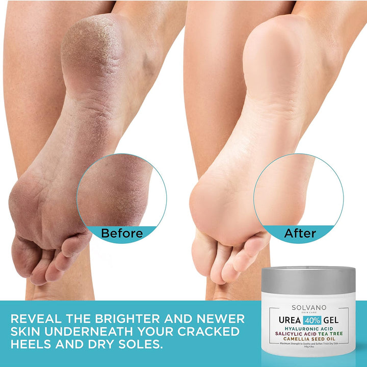 40% Urea Gel – Extra Strength for Rough, Dry Skin with Salicylic Acid & Tea Tree Oil – Includes Pumice & Brush - PA Cosmetics
